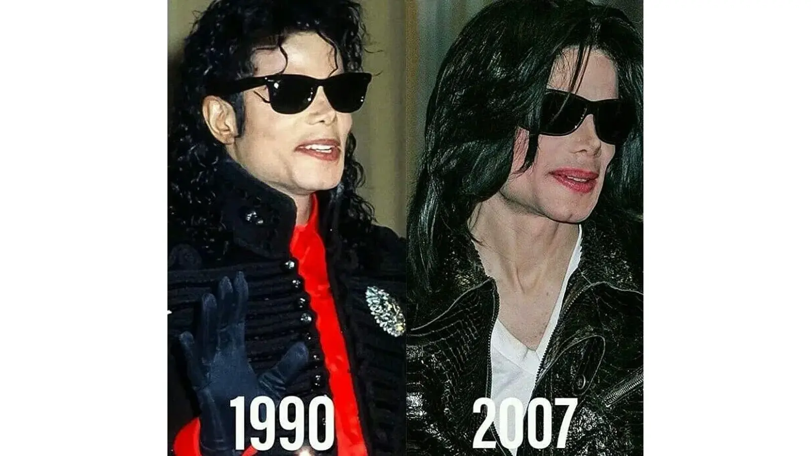 Side-by-side forensic comparison of Michael Jackson in the mid-1980s vs. the early 1990s, highlighting the progression of vitiligo depigmentation, systemic lupus inflammation, and reconstructive nasal architecture.