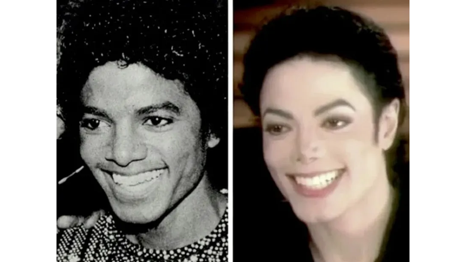 Side-by-side forensic comparison of Michael Jackson in the mid-1980s vs. the early 1990s, highlighting the progression of vitiligo depigmentation, systemic lupus inflammation, and reconstructive nasal architecture.