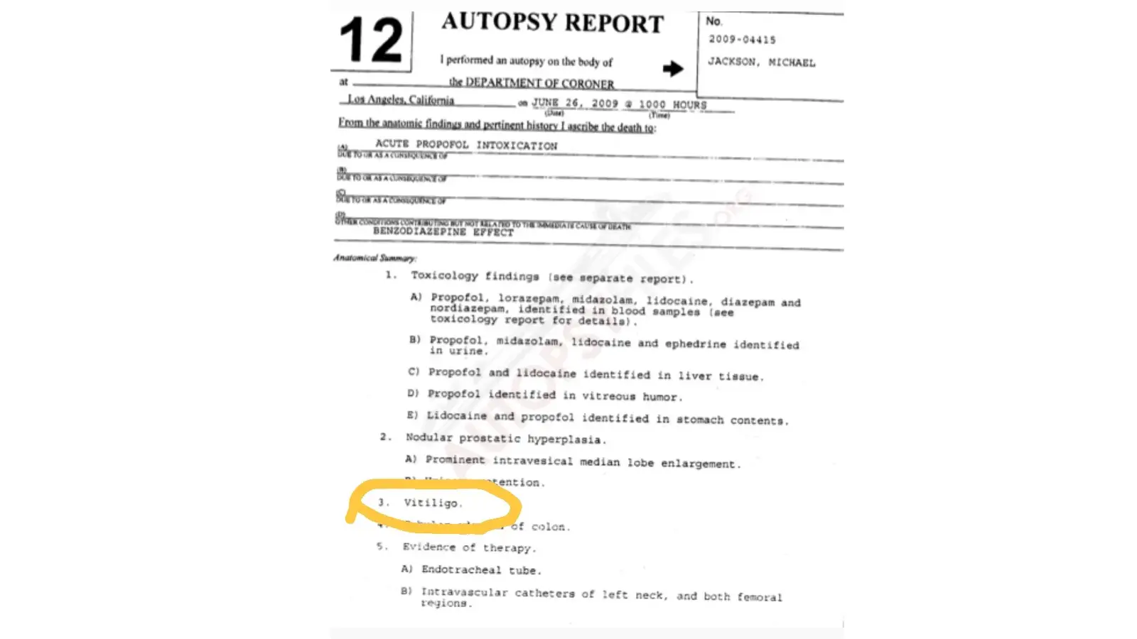 A clinical excerpt from Michael Jackson’s 2009 autopsy report identifying "focal depigmentation of the skin" and confirming the presence of vitiligo.