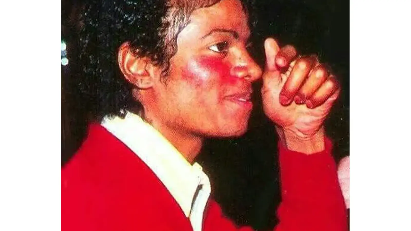 Close-up archival photo of Michael Jackson showing clinical signs of lupus on the cheek.